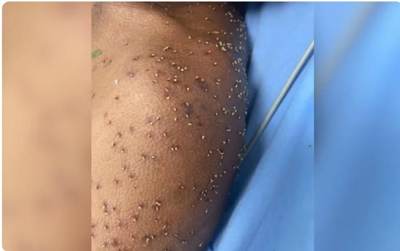 Trabalhador sofre centenas de picadas de abelhas durante serviço em fazenda de Goiás