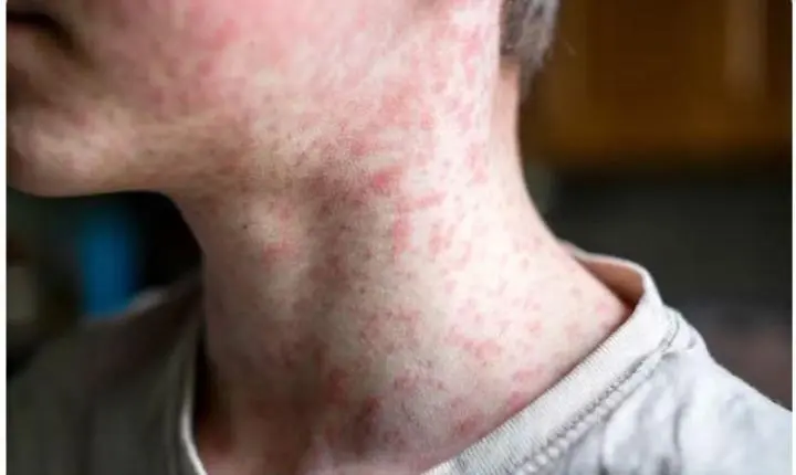 Sarampo: São Paulo confirma primeiro caso de 2026 em bebê após viagem à Bolívia