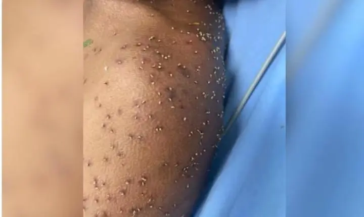 Trabalhador sofre centenas de picadas de abelhas durante serviço em fazenda de Goiás